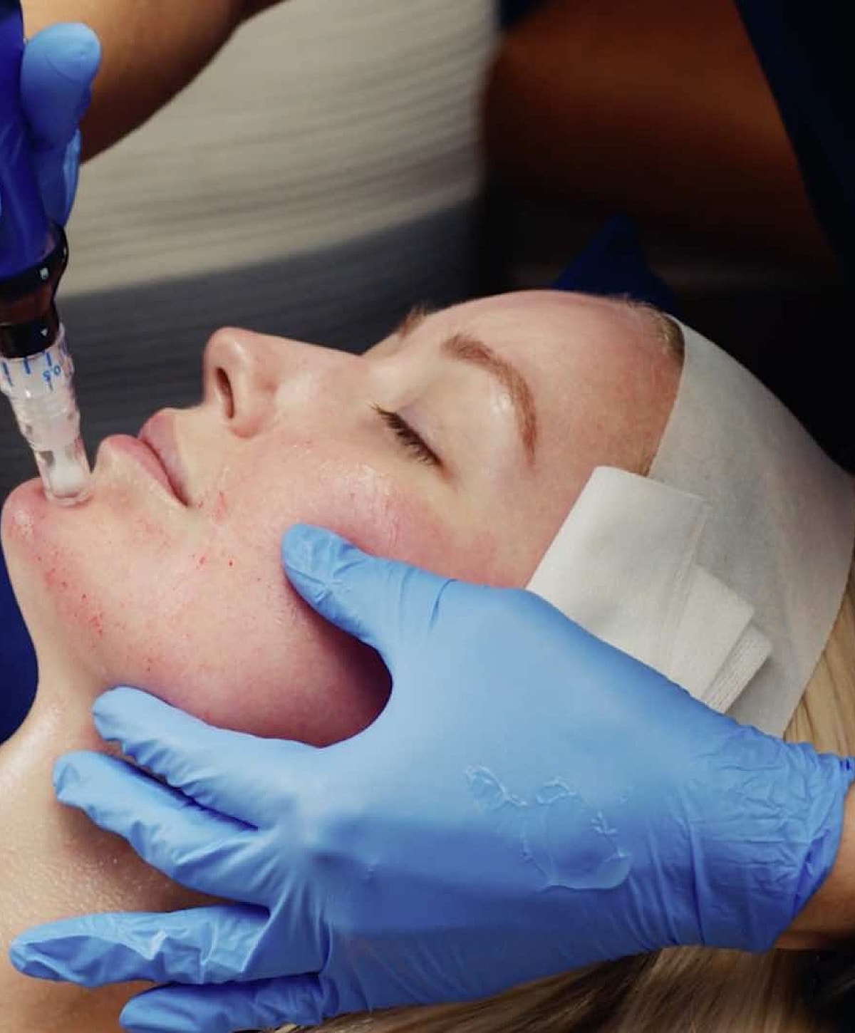 microneedling patient model receiving treatment on her chin