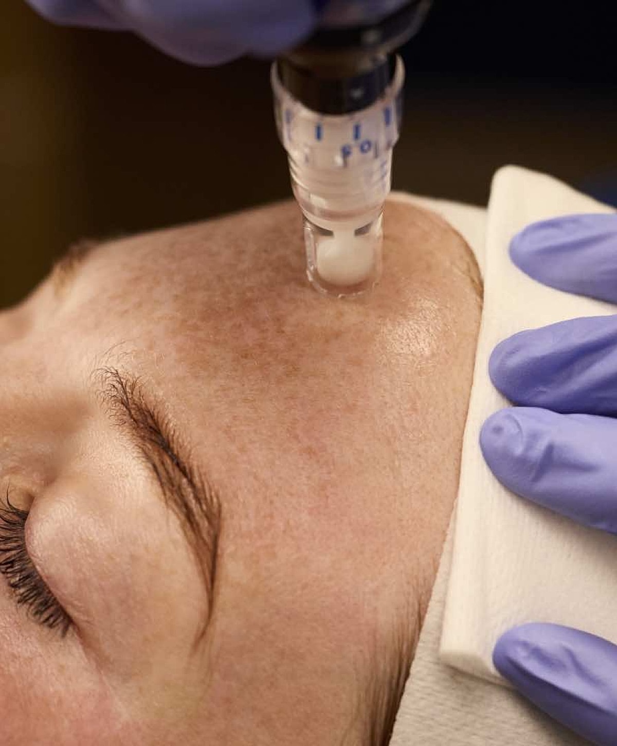 Microneedling treatment on a patient model's forehead.